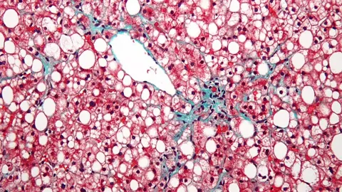 Síndrome Metabólica e Esteatose Hepática: Fisiopatologia da Lipotoxicidade e Terapia Nutricional