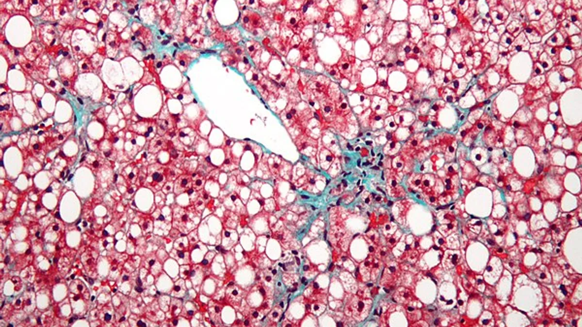 Síndrome Metabólica e Esteatose Hepática: Fisiopatologia da Lipotoxicidade e Terapia Nutricional